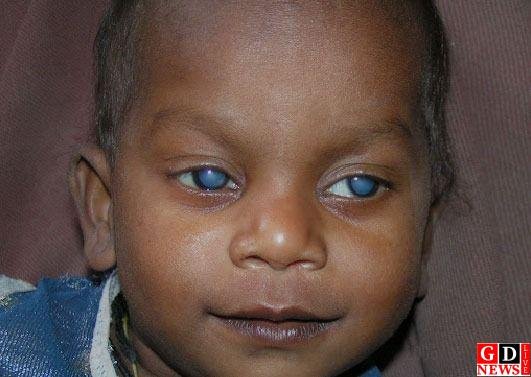 स्वास्थ्य सुविधाओं से वंचित महिलाओं एवं दृष्टि खो रहे बच्चों तक पहुँचना हमारी प्राथमिकता: - डॉ. भारती कश्यप 7 img 20241230 wa00067787844534437655185